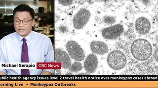 Canadian health officials issue travel notice over monkeypox