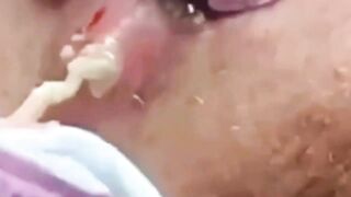 Best Biggest Pimple Popping And Cysts Compilation And Hacks