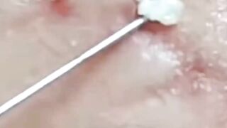 Best Biggest Pimple Popping And Cysts Compilation And Hacks