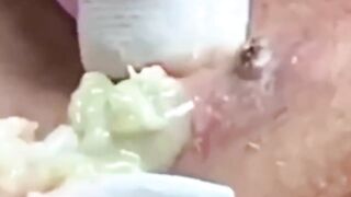 Best Biggest Pimple Popping And Cysts Compilation And Hacks