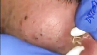 Best Biggest Pimple Popping And Cysts Compilation And Hacks