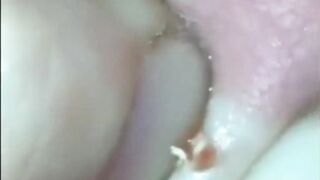 Best Biggest Pimple Popping And Cysts Compilation And Hacks