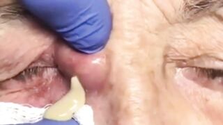 Best Biggest Pimple Popping And Cysts Compilation And Hacks