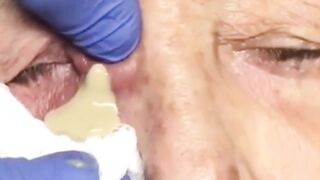 Best Biggest Pimple Popping And Cysts Compilation And Hacks