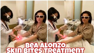 BEA ALONZO NAGPATREATMENT DAHIL SA NARANASANG SKIN BITES FROM HER RECENT BEACH TRIP