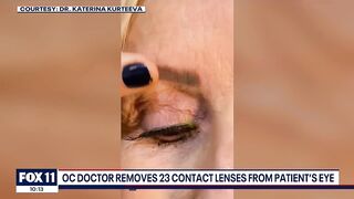 Newport Beach doctor removes '23 contact lenses' from patient's eye