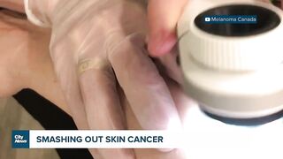 Celebrity fundraiser hoping to help end skin cancer