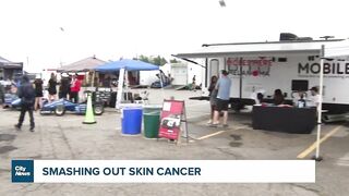 Celebrity fundraiser hoping to help end skin cancer