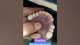 Upper Flexible Partial Denture By Haider #dentalartbyhaider #rpd #dentist #dentures