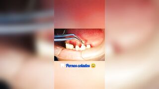 #Endodoncia, #perno, #coronas de #porcelana y #prótesis #flexible, #centrodentalinternacional, #Ate.