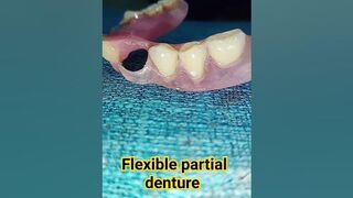 flexible partial denture by Ali dental ceramic #completedenture #partialdenture #removabledenture