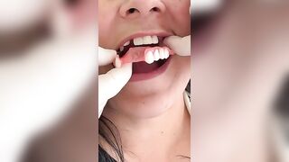 This flexible dental prosthesis is your solution #music #love #travel #viral #dentist #mrdent