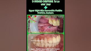 6 Implants + Fixed HYBRID Denture - Lower Jaw | Flexible PARTIAL Denture- Upper Jaw #implantshorts