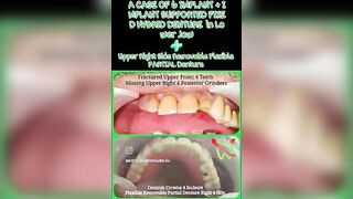 6 Implants + Fixed HYBRID Denture - Lower Jaw | Flexible PARTIAL Denture- Upper Jaw #implantshorts