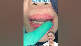 ✨CHANGE DENTURE TO FLEXIBLE DENTURES✨