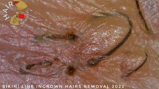 Long Ingrown Hairs On Bikini Line Women | Microscopic ZOOM | HAIR removal