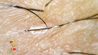 Long Ingrown Hairs On Bikini Line Women | Microscopic ZOOM | HAIR removal