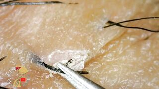 Long Ingrown Hairs On Bikini Line Women | Microscopic ZOOM | HAIR removal